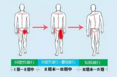 股骨头坏死的各种表现